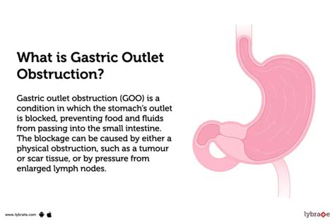 Spigelian Hernia of Stomach with Gastric Outlet Obstruction