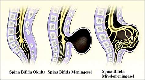 Spina bifida nedenleri