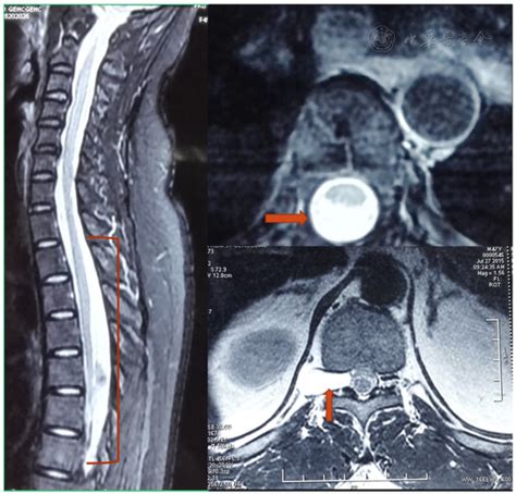 Spinal Cysts: Symptoms, Causes and Treatment - Atlantic Brain and Spin…