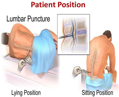 Spinal Tap Procedure (Lumbar Puncture Procedure)