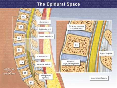Spinal epidural space Radiology Reference Article. 
