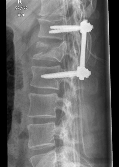 Spine fracture icd 10. S32.059A is a billable/specific ICD-10-CM code that can be used to indicate a diagnosis for reimbursement purposes. Short description: Unsp fracture of fifth lumbar vertebra, init for clos fx The 2024 edition of ICD-10-CM S32.059A became effective on October 1, 2023. 