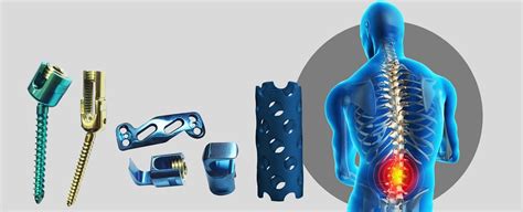 Spine industry news.  spinal implants Orthopedics This Week - The prem...