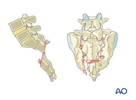 Spinopelvic fixation for C3 Displaced sacral U-type fracture