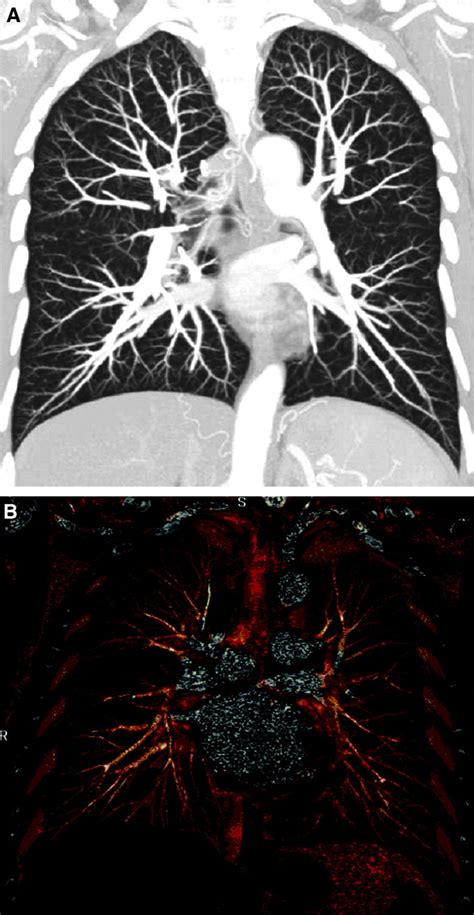 Spiral CT Angiography for Acute PE: Where Do We Stand?