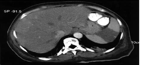 Splenic Infarction and Abscess in the Setting of Infective E ...