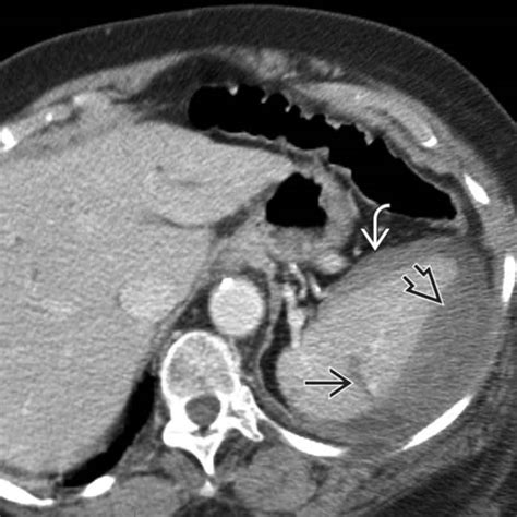 Splenic Trauma Radiology Key