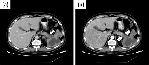 Splenic abscess caused by Streptococcu…