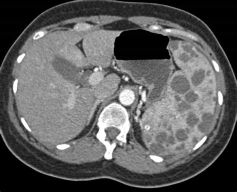 Splenic sarcoidosis - PubMed