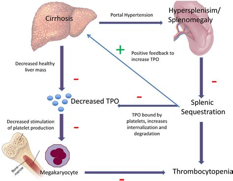 Splenomegaly and thrombocytopenia in patients with liver cirrhosis