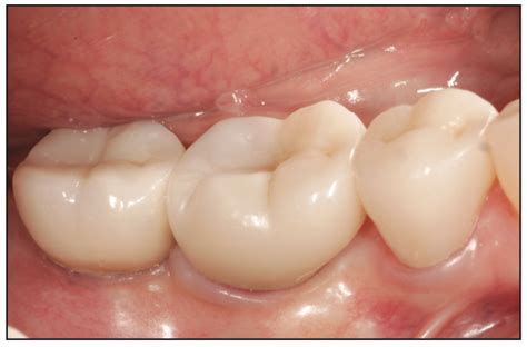 Splinted and Nonsplinted Crowns with Different Implant ... - Hindawi