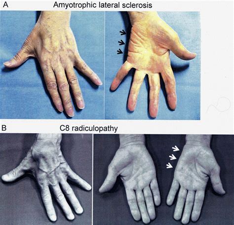 Split-hand index for amyotrophic lateral sclerosis diagnosis: A ...