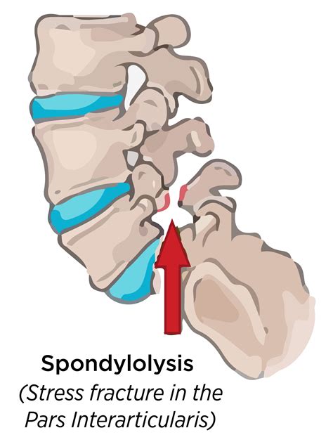 Spondylolysis: Causes, Treatment & Prevention - Cleveland Clinic