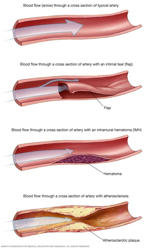 Spontaneous Coronary Disease in Women Artery Dissection (SCAD) - mayo…