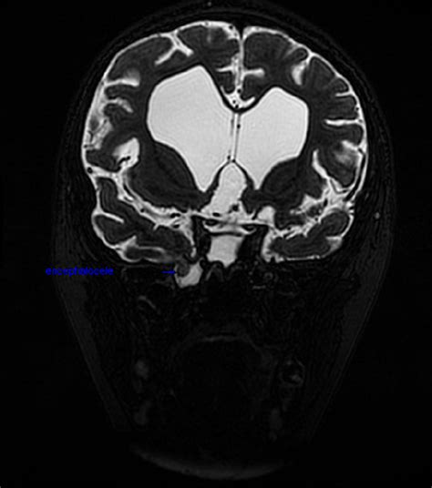 Spontaneous cerebrospinal fluid leak of the sphenoid sinus …