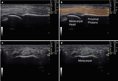 Sport Ultrasound Online Videos - Pathologies