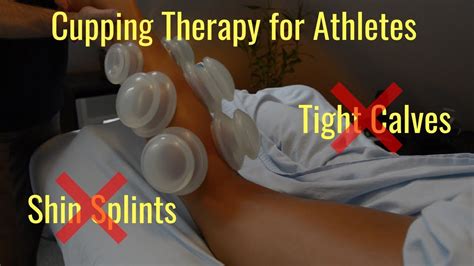 Download Sports Cupping A Beginners Guide To Cupping Therapy For Athletes At Any Level By Maggie Hansen
