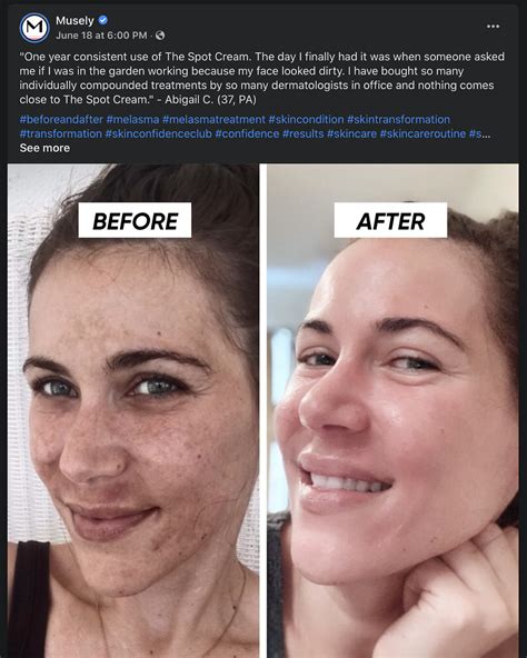  Product Review: So far so good! I started this treatment one week ago and the process with Musely has been seamless and absolutely great. Not too much peeling or dryness as yet. Cerave moisturizer and sun screen are recommended and are my best friends! Looking forward to the rest of the journey and transformation. . 
