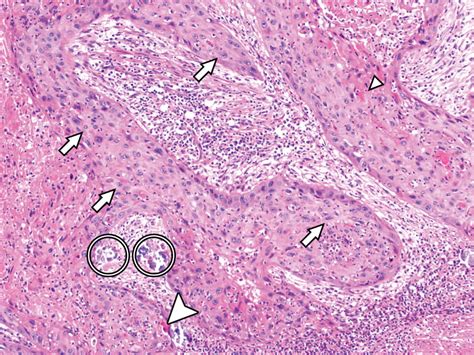 Squamous Cell Carcinoma of the Bladder Mimicking Interstitial ... - Hindawi