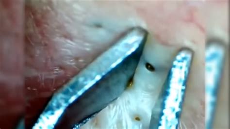 Deep blackhead extraction Cystic acne & pimple popping #114M