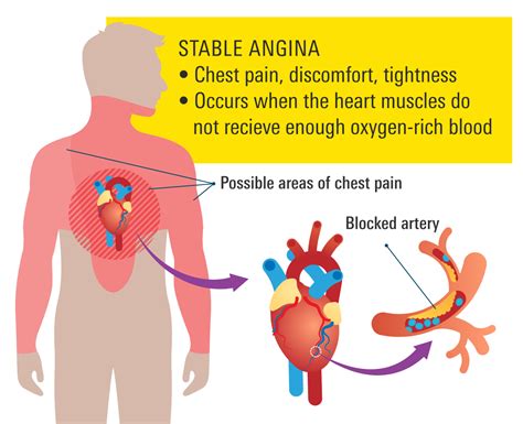 Stable angina causes. .  <a href=http://c-allworking.com/assets/images/t2z5nzt/...
