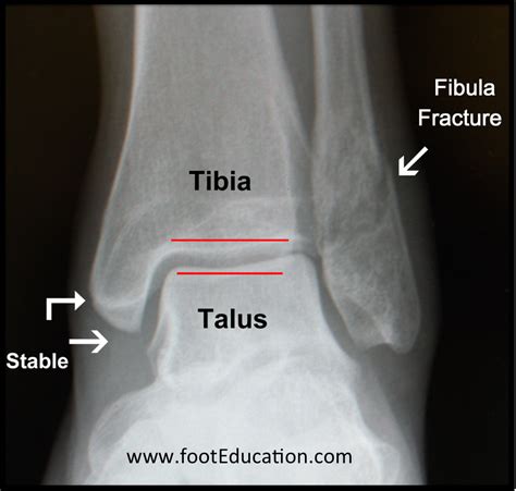 Stable fibula fracture.  #anklefracture #ankleinjury #anklesupport The Ankle Arthrodesis N...