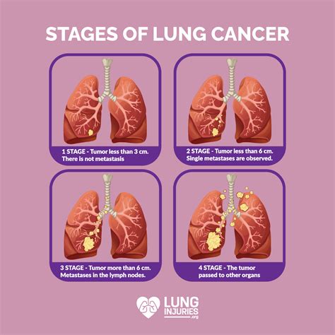 Stage 2 Lung Cancer: What To Expect MyLungCancerTeam