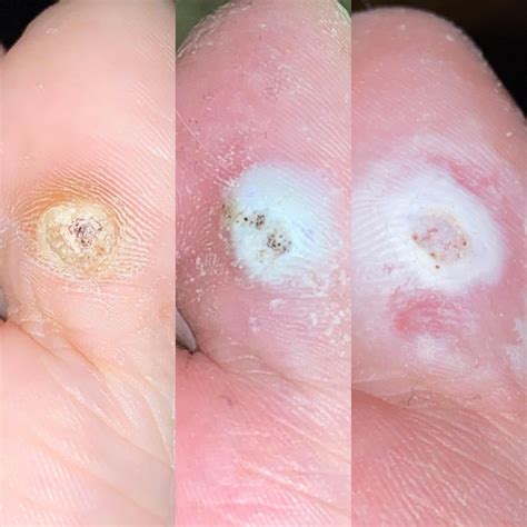 Apply to foot and cover with a clean cloth or bandage. You could also try rubbing the inside of a banana peel on the wart every night. The potassium is said to heal warts. Verify if the plantar wart is healing 1 2. It should be turning white, indicating that the skin cells are dying. Try to remove the wart with a scalpel or clippers.. 