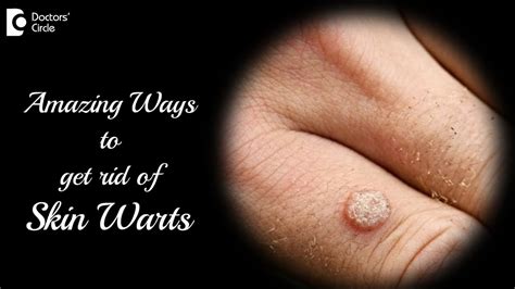 Stages of a wart falling off compound w. There are five main types of warts: 1. Common warts (aka vurruca vulgaris) Common warts are — shocker — common, and usually found on the hands, elbows or knees, Marie Jhin, a board-certified ... 