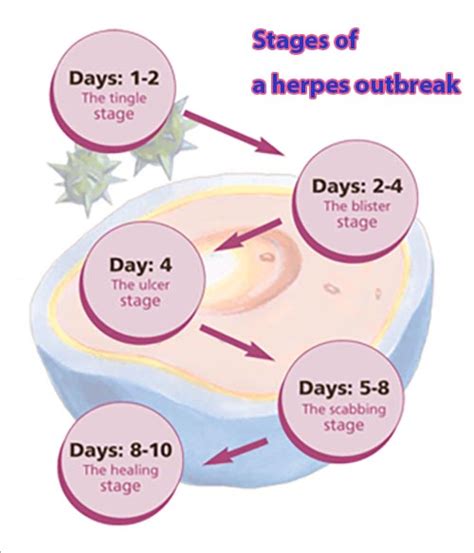Stages of herpes outbreak pictures. Vitamin deficiency. Surgery. Alcohol consumption. Smoking. Around 50% of people infected with genital herpes experience symptoms during the prodrome stage of each recurring outbreaks. These symptoms include redness, itching, tingling and pain around the genitals, buttocks, upper thighs and anus. 