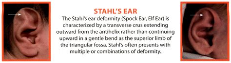 Stahls ears.  In Stahl&rsquo;s ear, there is a third horizontal crus.  The helix (or upper ...
