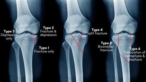 Standard of Care: Tibial Plateau Fracture - Brigham …