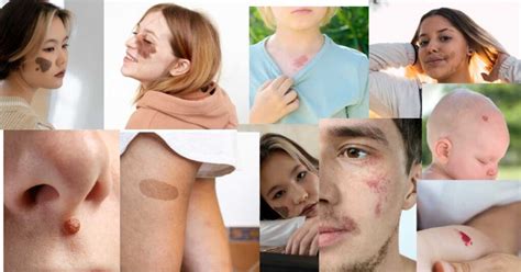 Starseed birthmarks. .  <a href=https://chou.osteopathie.ru:443/include/mainpage/j3spf/be...