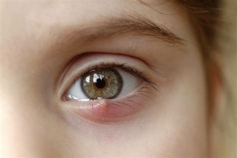 Staye - Aug 24, 2016 · Symptoms of a stye include a red lump on the eyelid similar to a pimple or boil, eyelid pain, eyelid swelling, and tearing. Difference between chalazion and stye – causes and risk factors. 