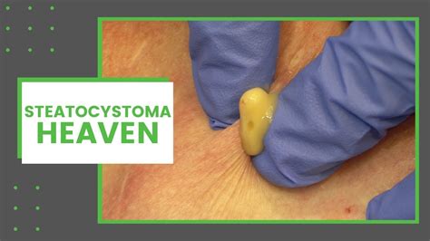 Steatocystoma removal videos. Mar 13, 2018 · Raining Cysts! Cyst Bursting, Popping, Explosion, Cysts on the back , Most Popular Cysts of All Time , Pimple popping infected sebaceous cyst , Surprise, it'... 
