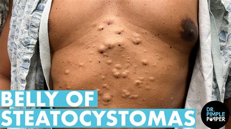 Steatocystomas popping. There are 25 whole minutes of nonstop steatocystoma popping action coming at you. Some of Dr. Pimple Popper's fans recognized the patient as Momma Squishy in the comments. Dr. Pimple Popper uses ... 