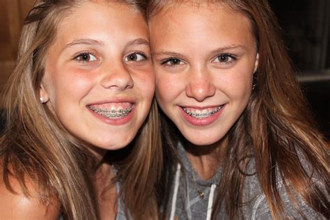 Step sister braces. There are two types of braces that could conceivably be covered by PeachCare for Kids. The first are dental braces, which are not covered. The second are orthotic braces, which may... 