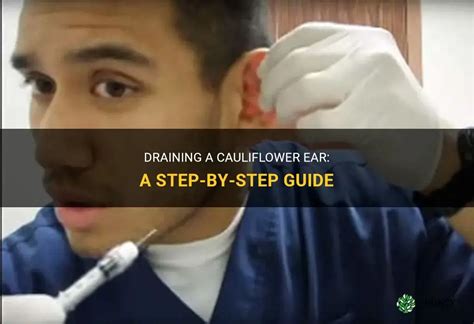 Step-by-Step DIY Guide To Drain Cauliflower Ear On Your Own