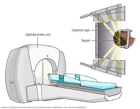 Stereotactic Radiosurgery of the Brain: LINAC - MayfieldClinic.com