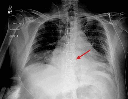 In some people, the depth of the indentation worsens in early adolescence and can continue to worsen into adulthood. In severe cases of pectus excavatum, the breastbone may compress the lungs and heart. Signs and symptoms may include: Decreased exercise tolerance. Rapid heartbeat or heart palpitations. Recurrent respiratory infections.. 