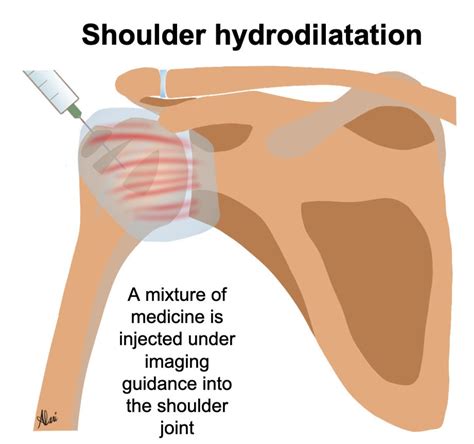 Stiff Shoulder and Hydrodilatation Injection …