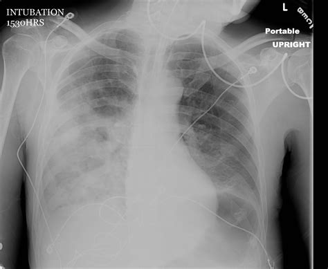 Still have tightness in chest after pneumonia - Patient