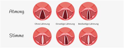 Stimmbandlähmung nach Herz-OP MEDICAL VOICE CENTER