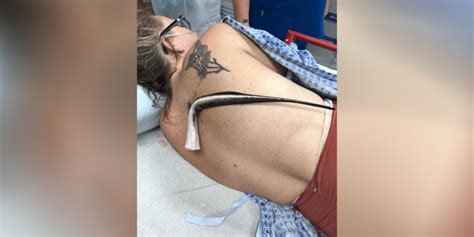 Stingray impales Florida woman's back, misses lung by centimeters: 'Super, super painful'