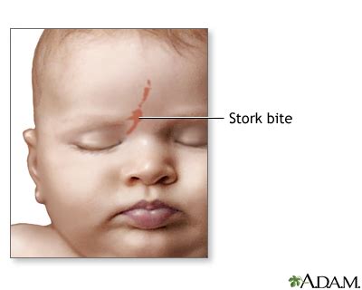 Symptoms. A stork bite usually looks pink and flat. A baby may be born with a stork bite. It may also appear in the first months of life. Stork bites may be found on the forehead, eyelids, nose, upper lip, or back of the neck. Stork bites are purely cosmetic and do not cause any symptoms. . 