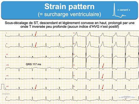 Strain pattern ecardiogram