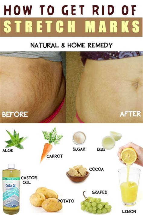 Stretch Marks on Breasts Causes,Get rid Home Remedies