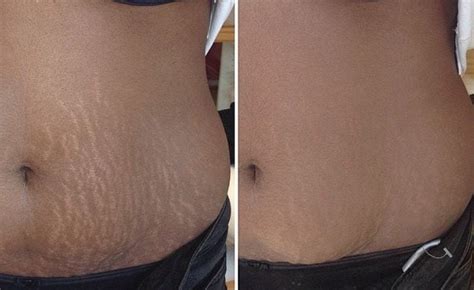 Stretch mark tattoos. Camouflage (also known as Paramedical Tattoo and Micropigmentation) is the technique of inserting pigment into the dermis of the skin for results similar to permanent makeup. This treatment helps to conceal the stretch mark/scar and will lighten or darken the area to match the natural pigmentation of the skin. 