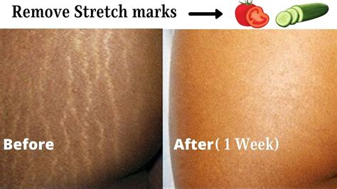 Stretch marks and what can be done about them