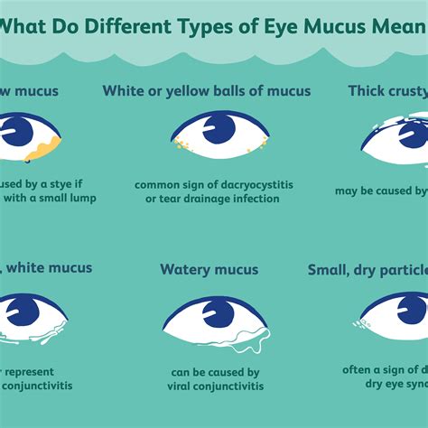 Stringy eye mucus.  Apr 5, 2024 · Another common condition, dry eye, ca...